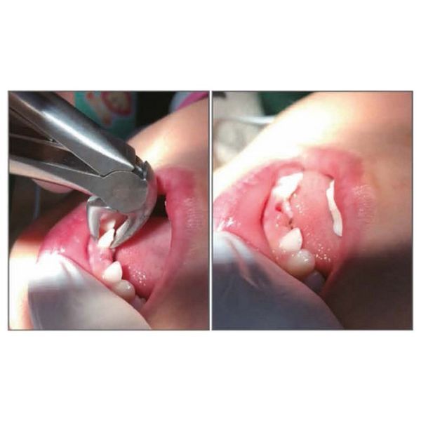 Легкі щипці для дітей 3259s Easy Forceps For Children Mandibular Anterior Tooth фото